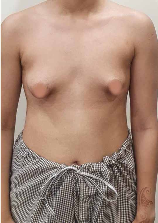 What are the Causes of Tuberous Breasts? - Best Plastic Surgeon in