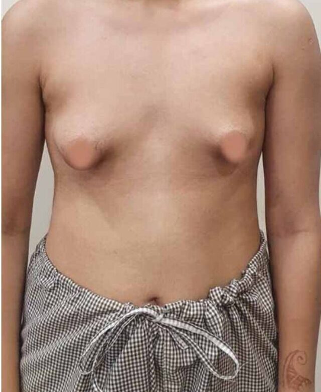 Tuberous breast