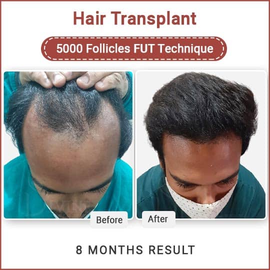 Fut hair transplant result