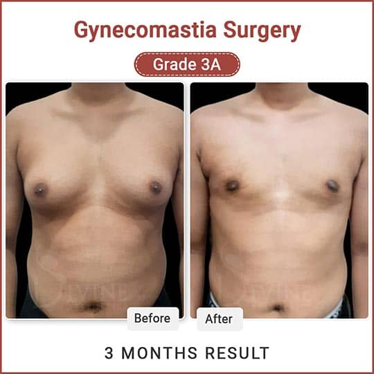 gynecomastia surgery result