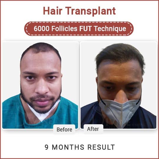 hair transplant before after