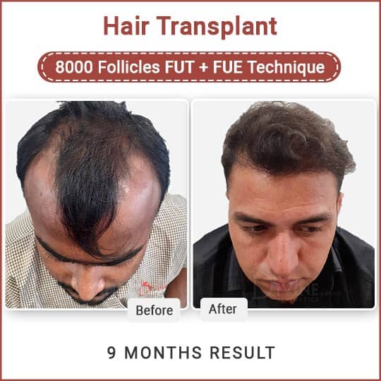 Fue and Fut hair transplant result