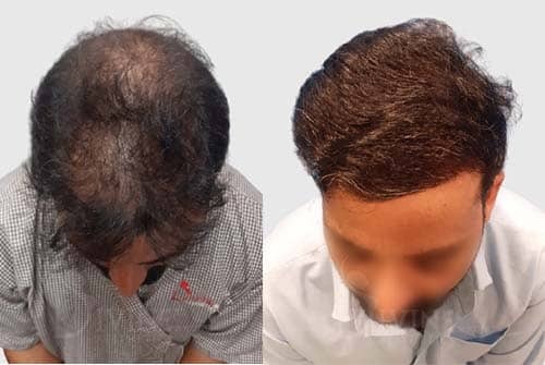 hair transplant cost is worth the investment
