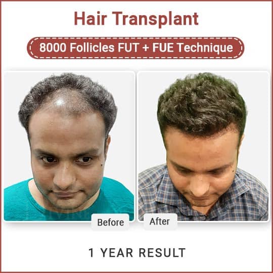 hair transplant result
