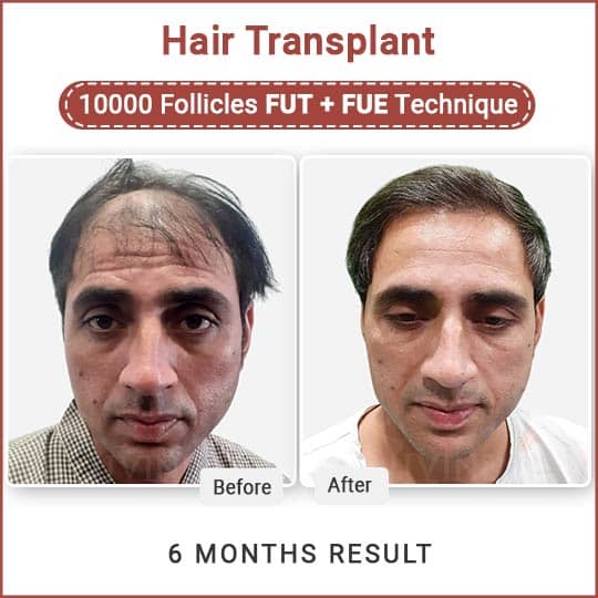 Best fut and fue hair transplant result