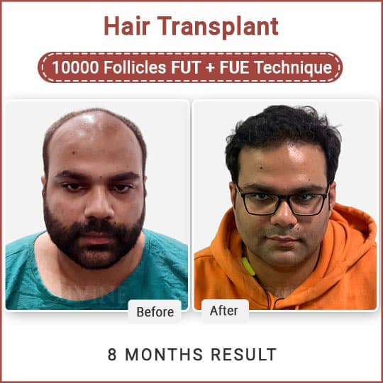 Hair Transplant in Bangalore, Best Surgeon & Affordable Cost