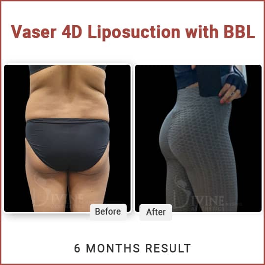 cost of Brazilian buttock lift in India