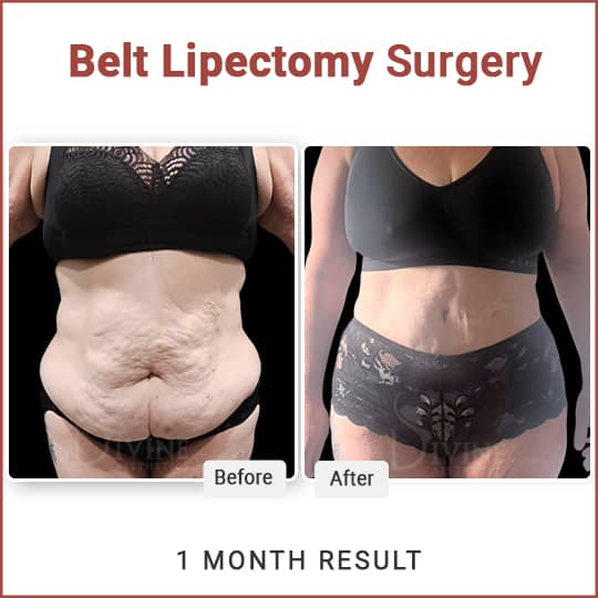 Belt Lipectomy surgery result