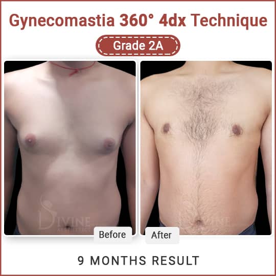 Best Gynecomastia Surgery Clinic