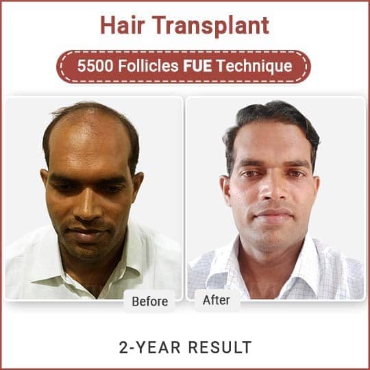 Best hair Transplant Clinic in Delhi
