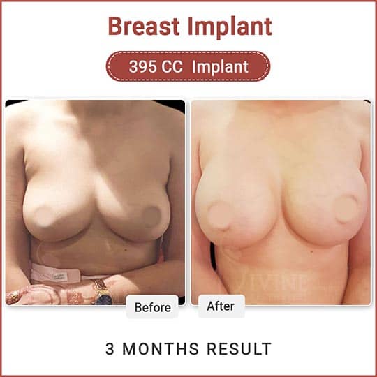 Breast Enlargement Surgery and Treatment in Delhi NCR