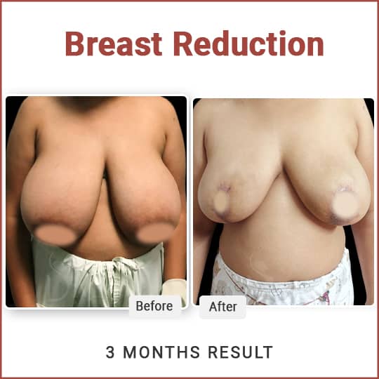 Breast Reduction Surgery in Delhi