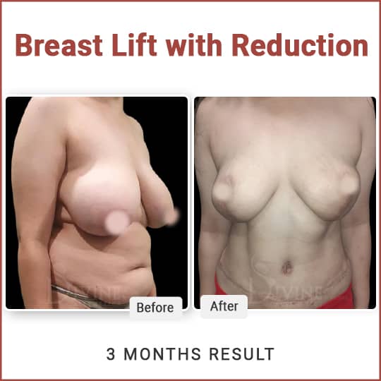 Breast Reduction with Breast Lift Result