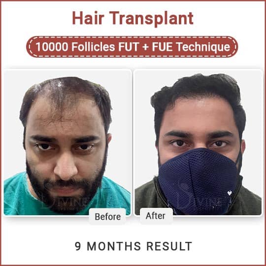 FUE Hair Transplant Delhi