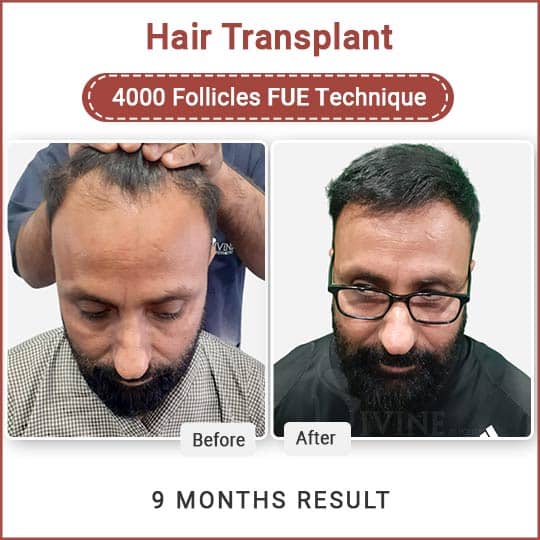 FUE hair transplant in Delhi