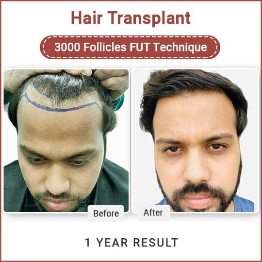 FUT Hair Transplant in India