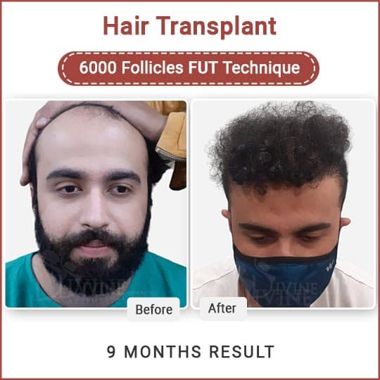 FUT Hair Transplant Surgery