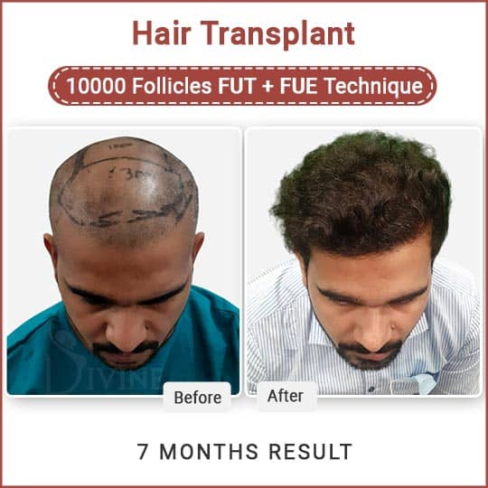 FUT and FUE Hair Transplant