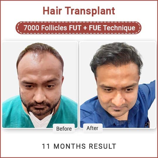 Fue and Fut Hair transplant in India