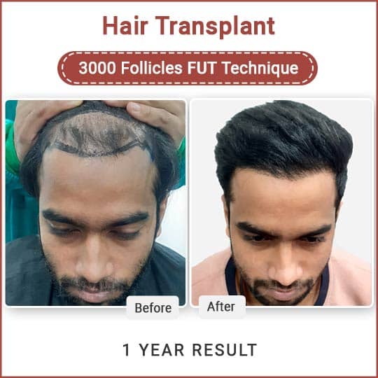 Fut Hair Transplant in Delhi
