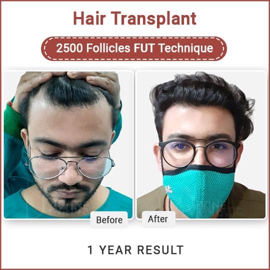 Fut technique hair transplant result