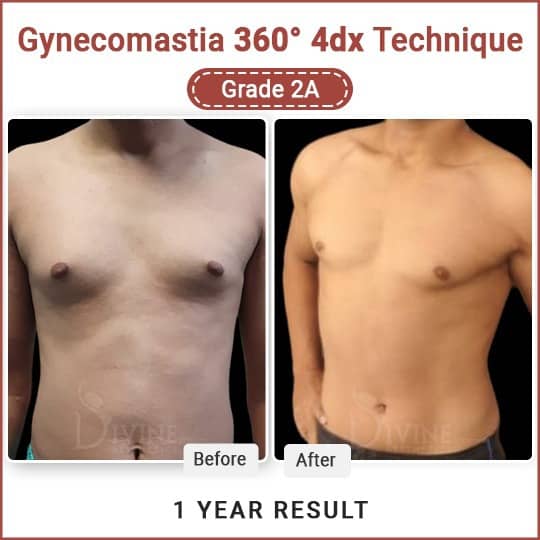 Gynecomastia Surgery Cost in Delhi and Best Surgeon