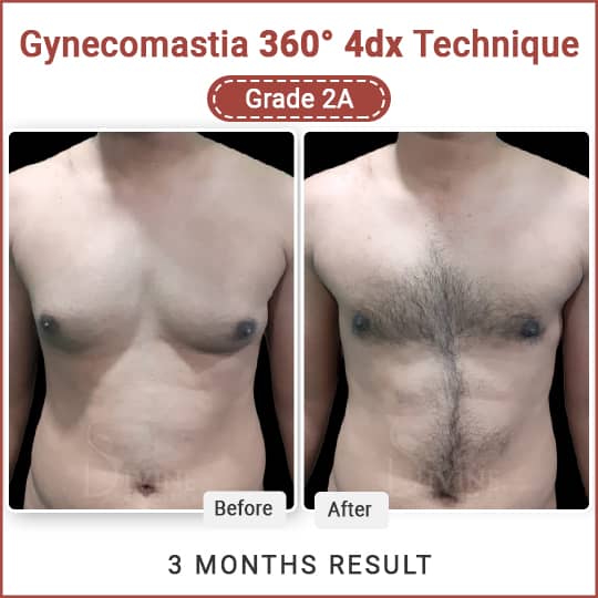 Gynecomastia surgery cost and best result