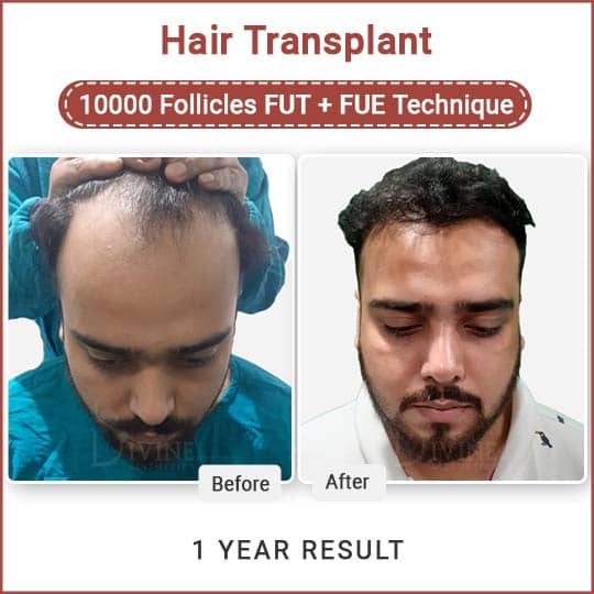 Hair Transplant Result India