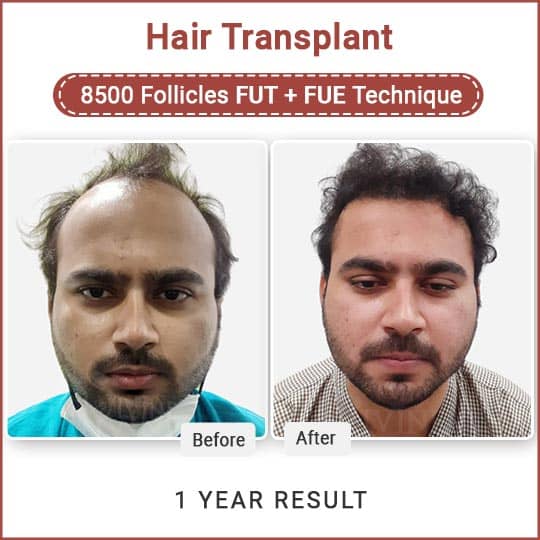 Hair transplant Cost in Delhi