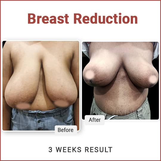 Breast Reduction surgeon in Delhi