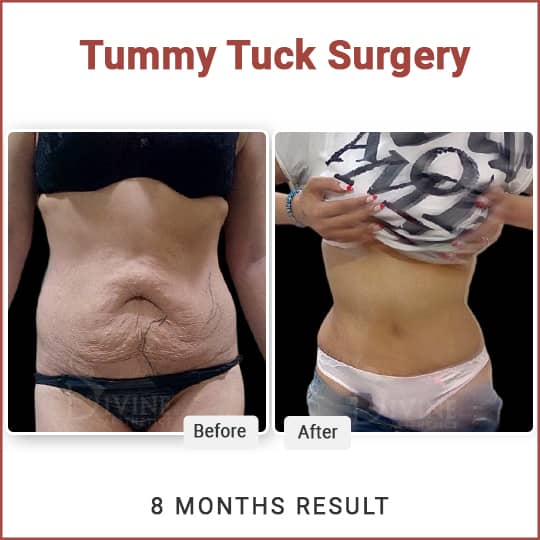 Tummy Tuck Before and After Results