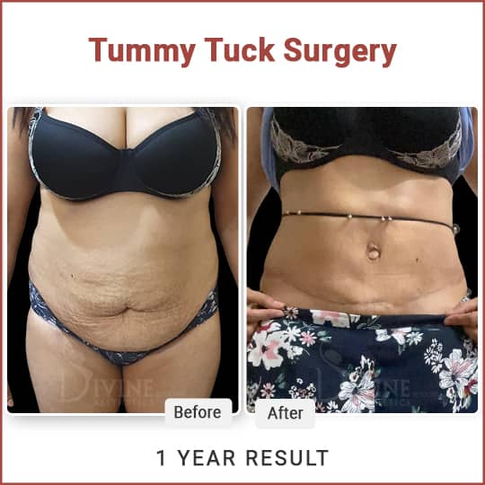 Tummy Tuck Surgery Result