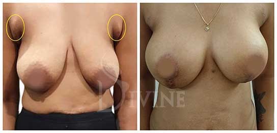What is Axillary Fat - axillary or armpit fat before and after