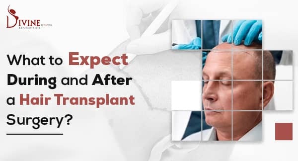 What to Expect During and After a Hair Transplant Surgery