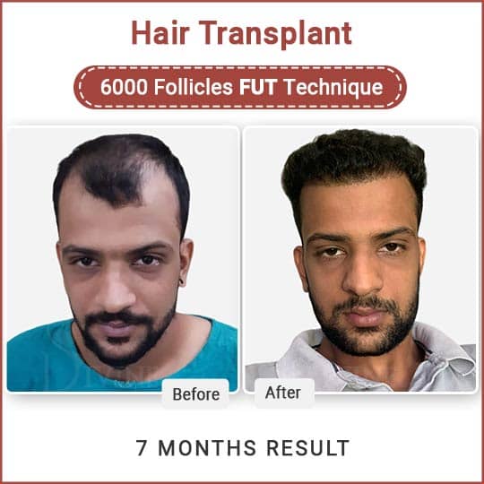 best hair transplant surgery in Delhi