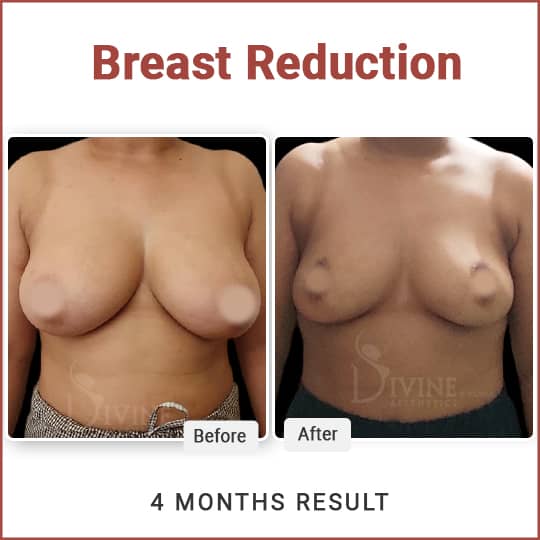 breast reduction surgery cost in delhi