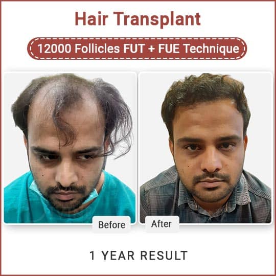 fue hair transplant + fut hair transplant