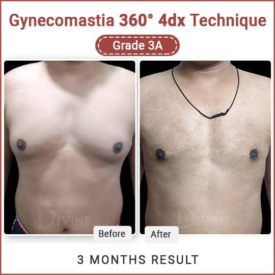 gynecomastia surgery cost and best clinic in delhi