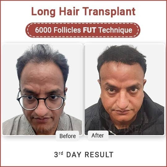 long hair transplant before after