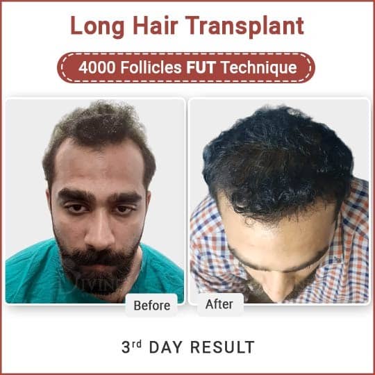 long hair transplant clinic in Delhi