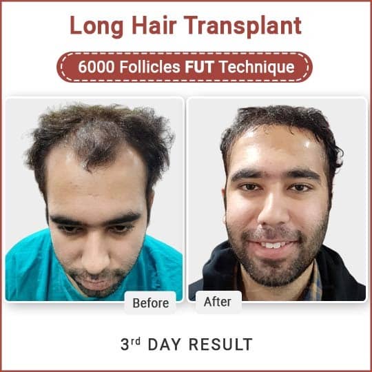 long hair transplant cost in Delhi