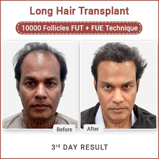 long hair transplant doctor in delhi