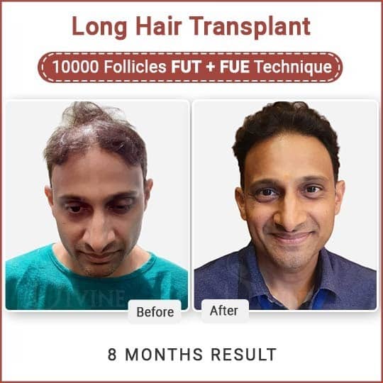 long hair transplant result