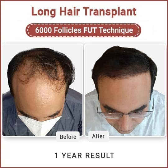long hair transplant result