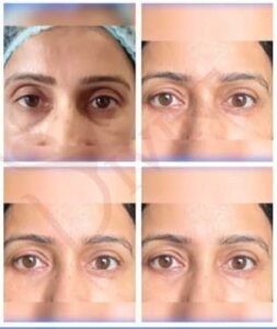 Eyelid Lift - Everything You Should Know About Blepharoplasty Surgery