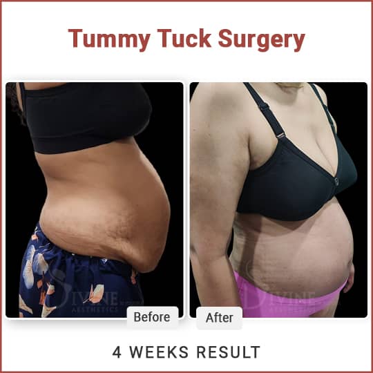 Difference Between a Full Tummy Tuck and a Mini Tummy Tuck