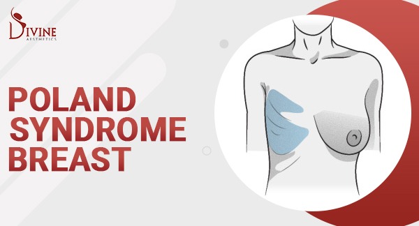 Poland Syndrome - Causes, Symptoms and Treatment in India