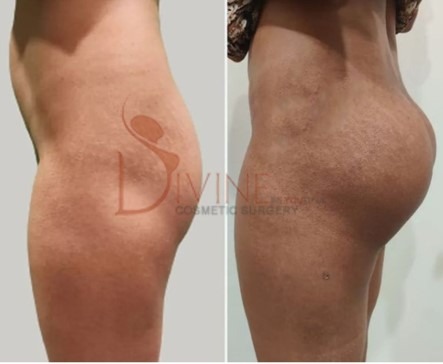 Buttock Augmentation with Implants in India