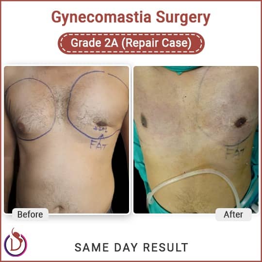 Common Reasons For Gynecomastia Revision Surgery