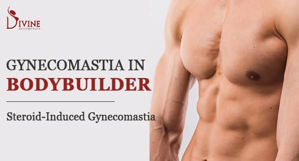 Steroid Induced Gynecomastia , Bodybuilder Gyno